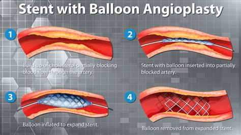 Recovering from Angioplasty