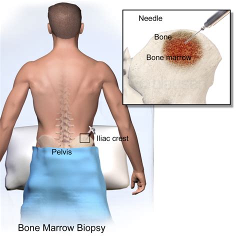 recovering from bone marrow biopsy