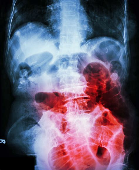 Recovery After Bowel Obstruction Surgery