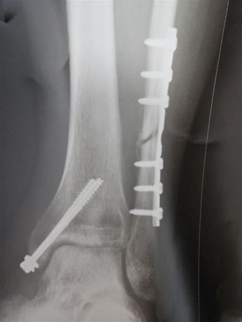 Recovery after ORIF