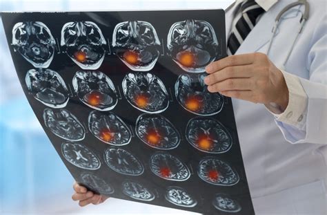 Recovery and Prognosis