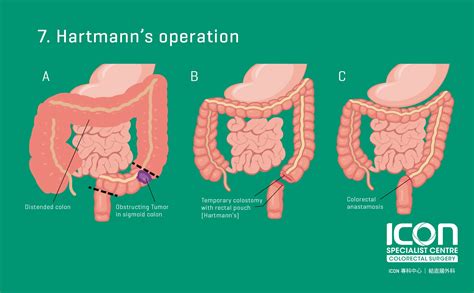 recovery from colon resection surgery
