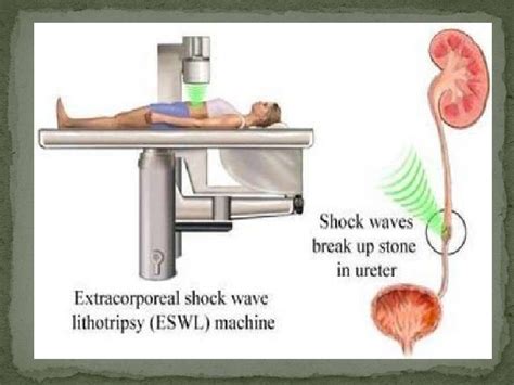 lithotripsy recovery