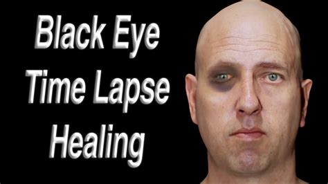Recovery Time for Black Eye