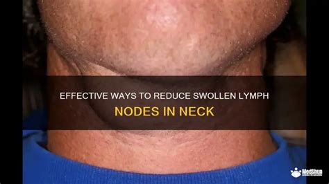 reducing swollen lymph glands