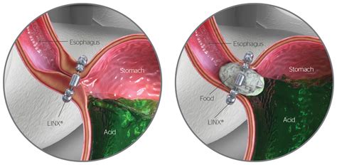 Reflux Management