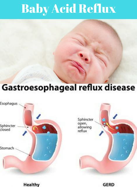Reflux in Newborns