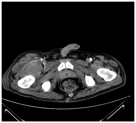 Research on Hematomas