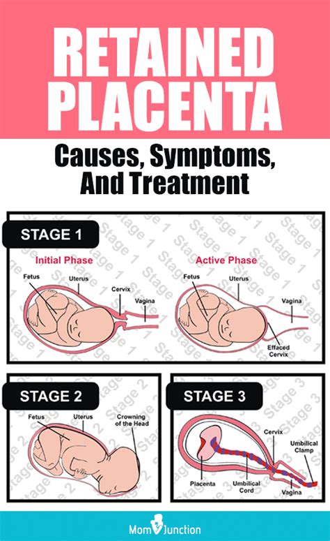 Retained Placenta Causes