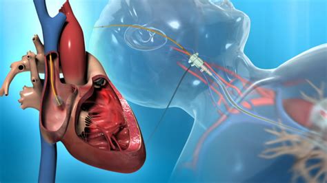 right heart catheterization future