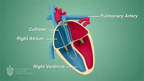 right heart catheterization procedure