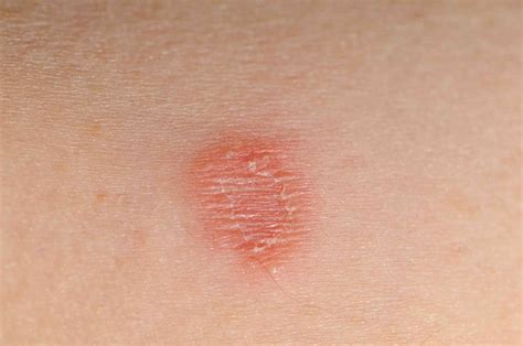 Ringworm causes