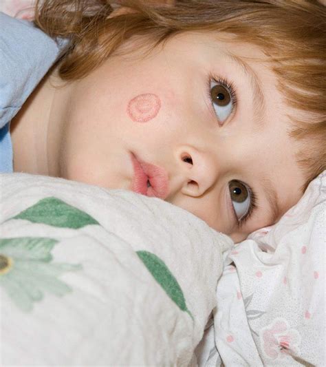 Ringworm children
