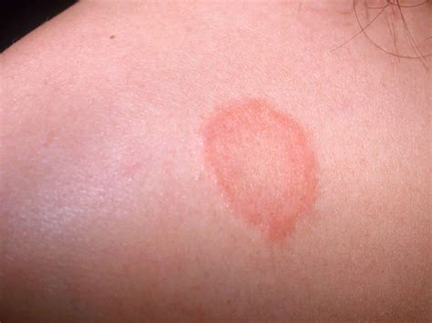 Ringworm complications