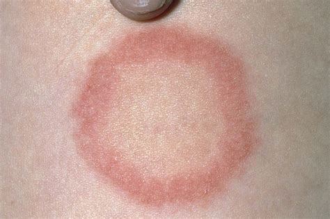 Ringworm mental health