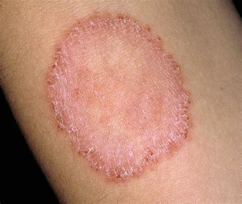 Ringworm symptoms