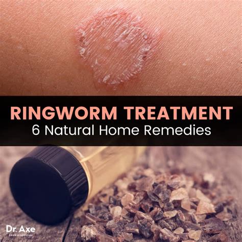 Ringworm treatment