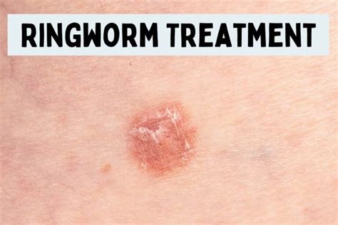 Ringworm Treatment FAQs