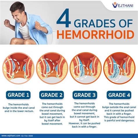 Risks and Complications of Hemorrhoid Surgery
