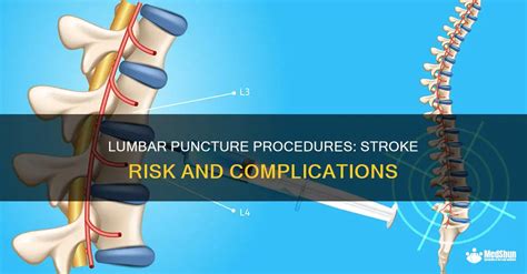 Risks and Complications of Lumbar Puncture Procedure