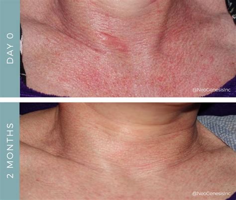 Rosacea on chest FAQ