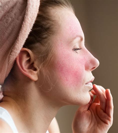 Rosacea on chest home remedies