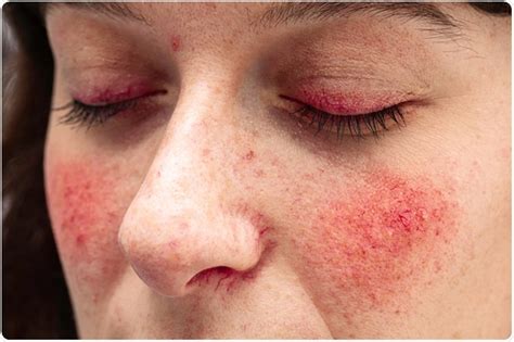 Rosacea on chest prevention