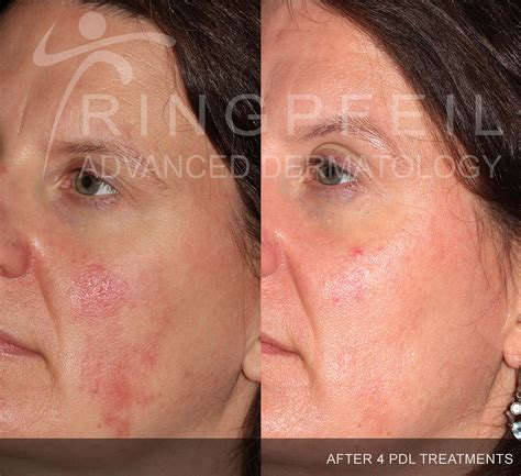Rosacea Treatment