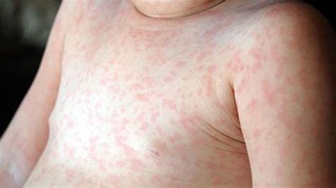 roseola home remedies