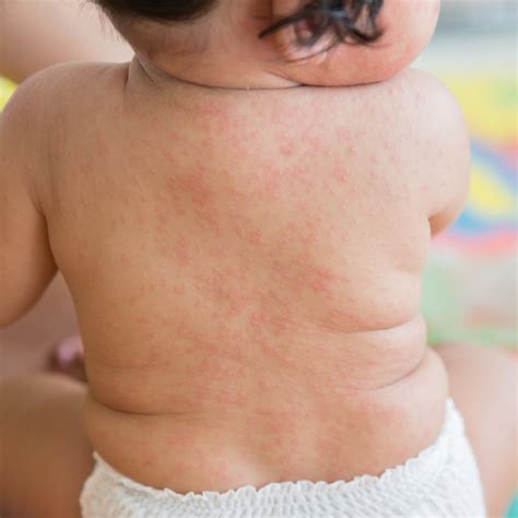 roseola when to seek medical attention