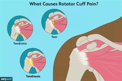 Rotator cuff pain illustration