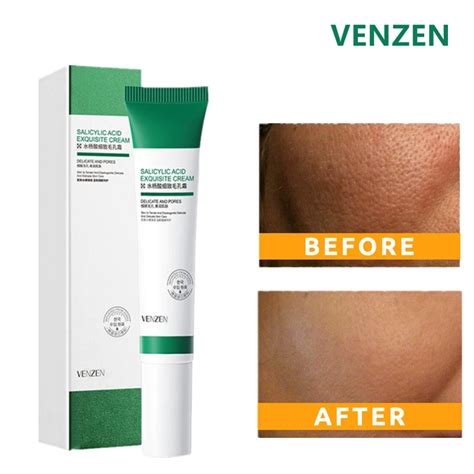 Salicylic Acid Cream for Anti-Aging