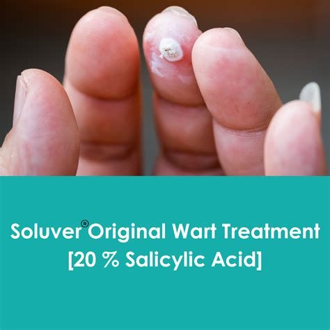 salicylic acid for warts treatment