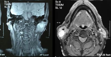 salivary gland diagnosis