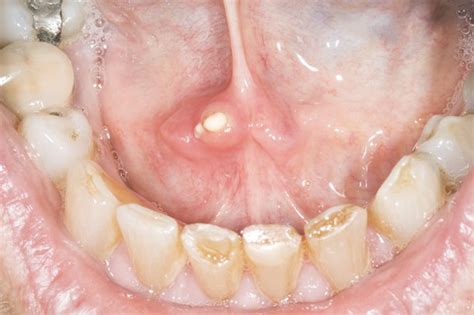 Salivary gland stones formation