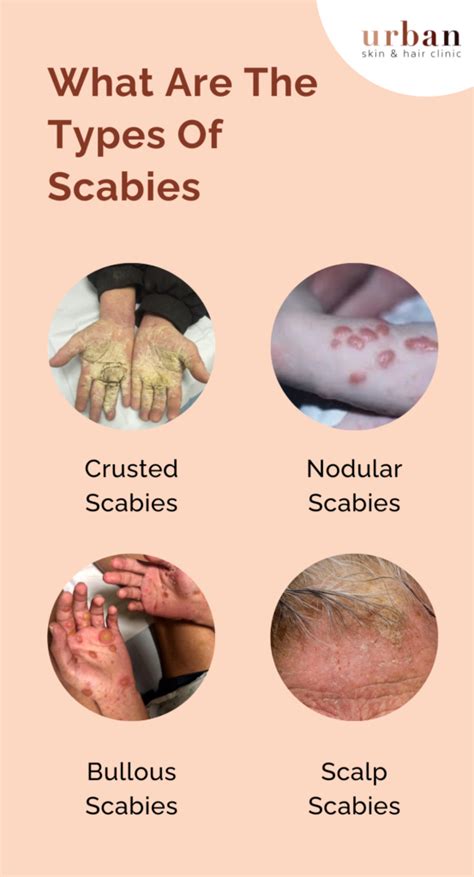scabies causes