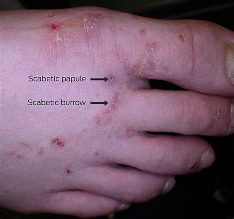 scabies conclusion