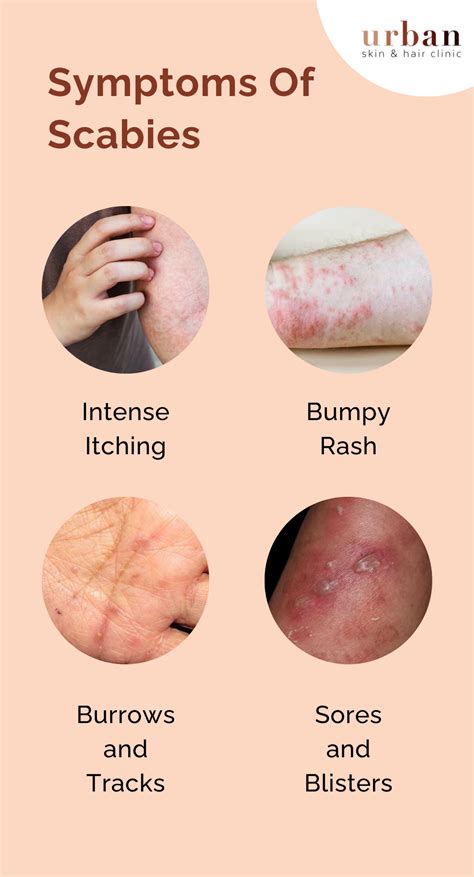 scabies diagnosis