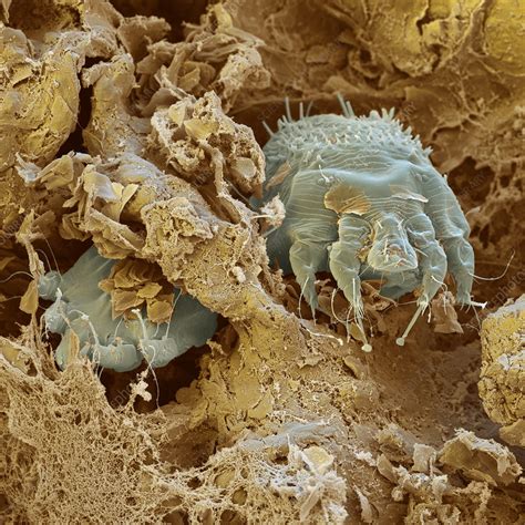 scabies mite