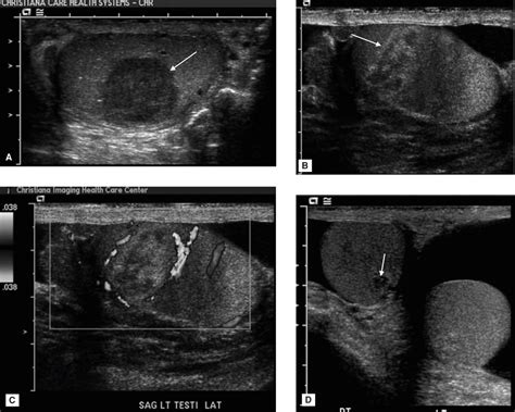 Scrotum Cyst Living