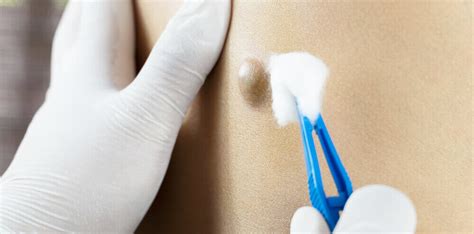 Scrotum Cyst Self-Care