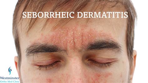 ketoconazole cream for seborrheic dermatitis