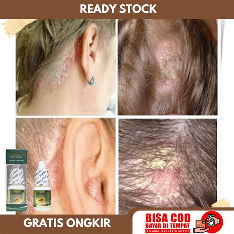 Seborrheic Dermatitis and Lichen Planus