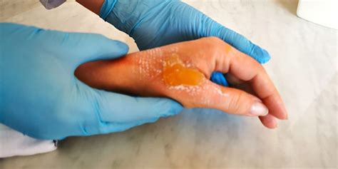 Second-degree burn symptoms