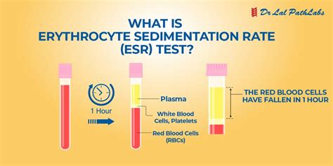 sed rate sedimentation test used in conjunction with other laboratory tests
