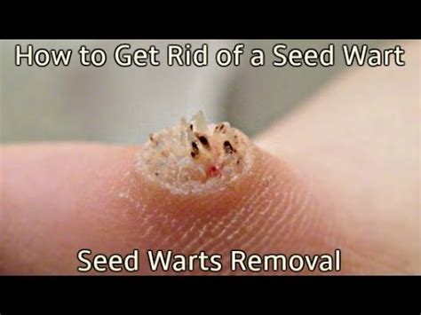 Seed wart causes