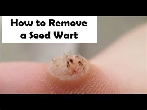 Seed wart treatment