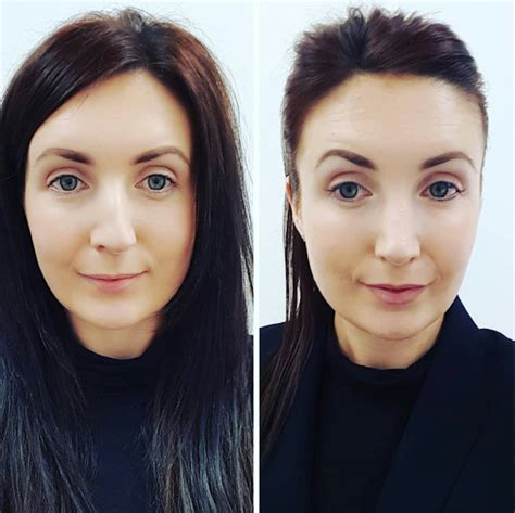Benefits of Deviated Septum Surgery