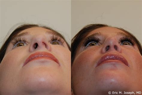 Preparation and Recovery for Deviated Septum Surgery