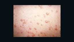 Severe shingles vaccine reactions